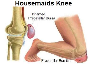 Housemaids-knee-prepatellar-bursitis.jpg